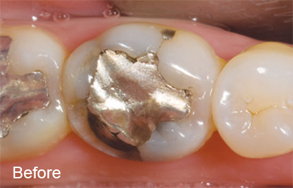 Before Dental Restoration - Photo of Molar