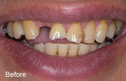 Patient's teeth photo before BruxZir Esthethic zirconia crowns