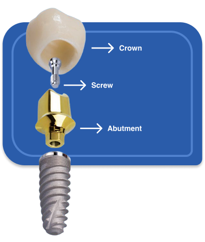 Abutment and Crown​ desktop