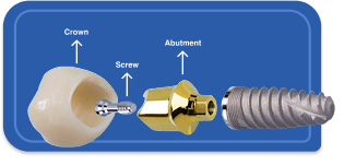 Abutment and Crown​ mobile