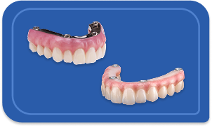 Implant Denture- mobile