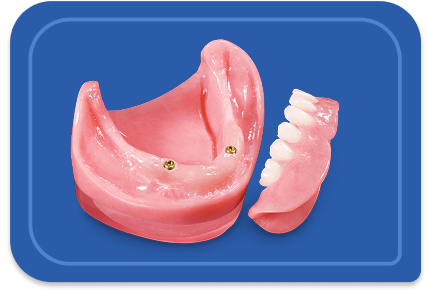 Locator® Implant Overdenture