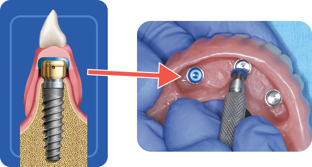 Retentive Caps Options