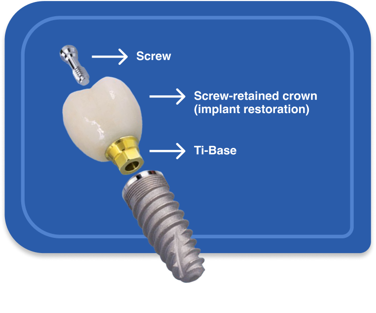 Screw Retained Crown mobile