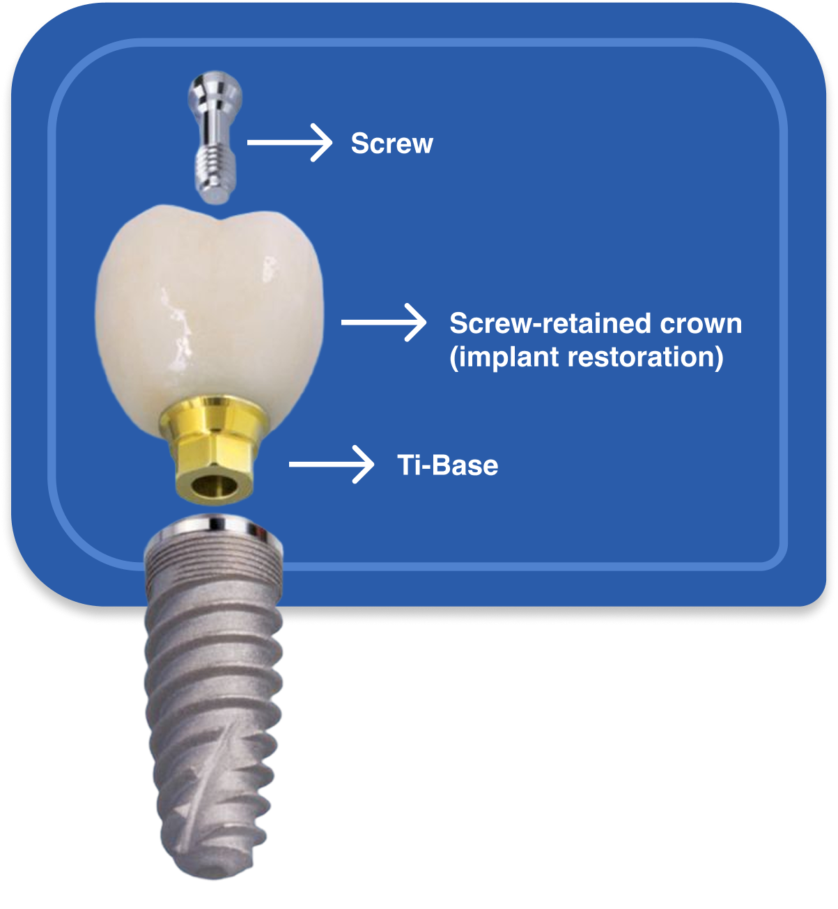 Screw Retained Crown