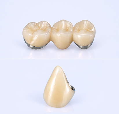Porcelain Fused To Metal​
